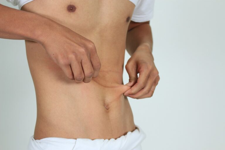 abdominoplastie