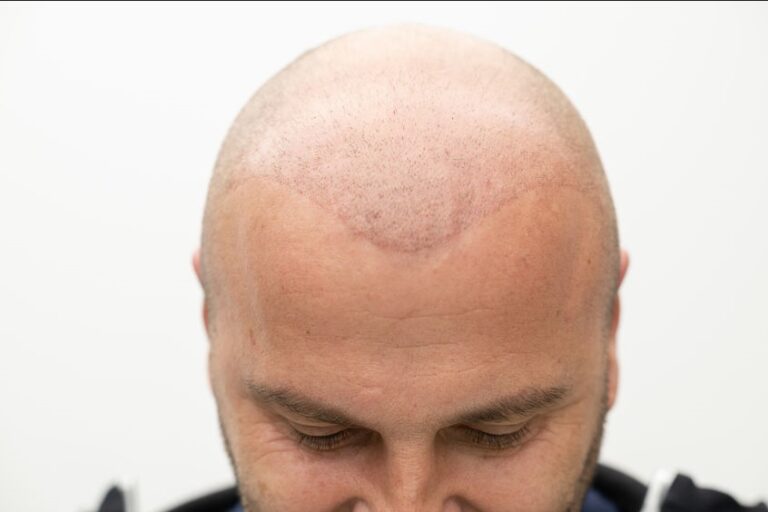 prothèse capilaire pour homme